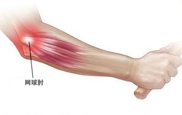 網(wǎng)球運動常見的運動損傷